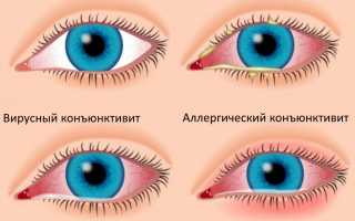 Синдром «красного глаза»
