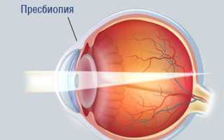Пресбиопия