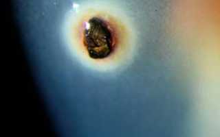 Инородное тело роговицы