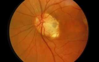 Ямка диска зрительного нерва