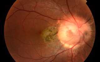 Колобома зрительного нерва