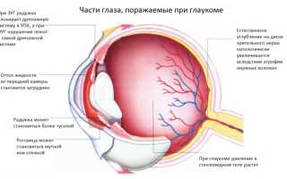 Глаукома