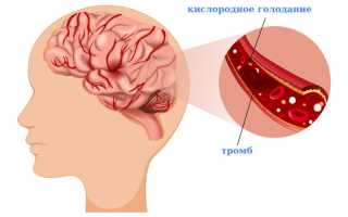 Отёк мозга и его последствия при инсульте