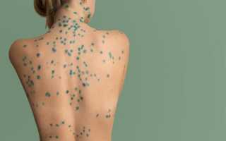 Причины развития поноса при ветрянке и методы оказания помощи