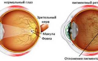 Клинические формы пигментного ретинита