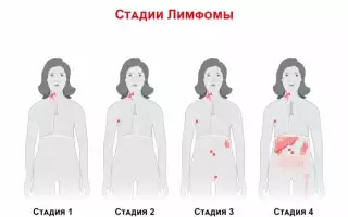 Лимфомы