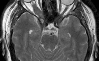 Опухоли зрительного нерва