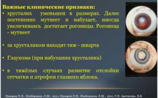 Аномалии развития хрусталика