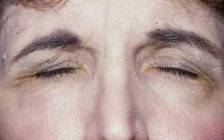 Идиопатический блефароспазм