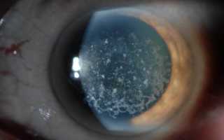 Дистрофии роговицы