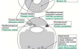Поражение органа зрения при саркоидозе