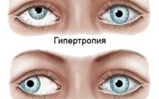 Содружественное косоглазие