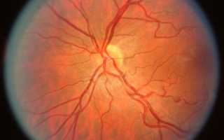 Косое вхождение диска зрительного нерва