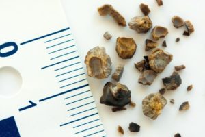 Чем растворить камни в почках народными средствами