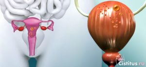 Эндометриоз и уретрит