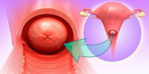 Эндометриоз и уретрит