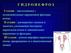 Пиелоэктазия почек у новорожденного слева