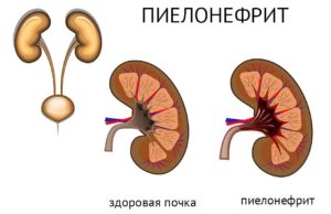 Воспаление левой почки причины