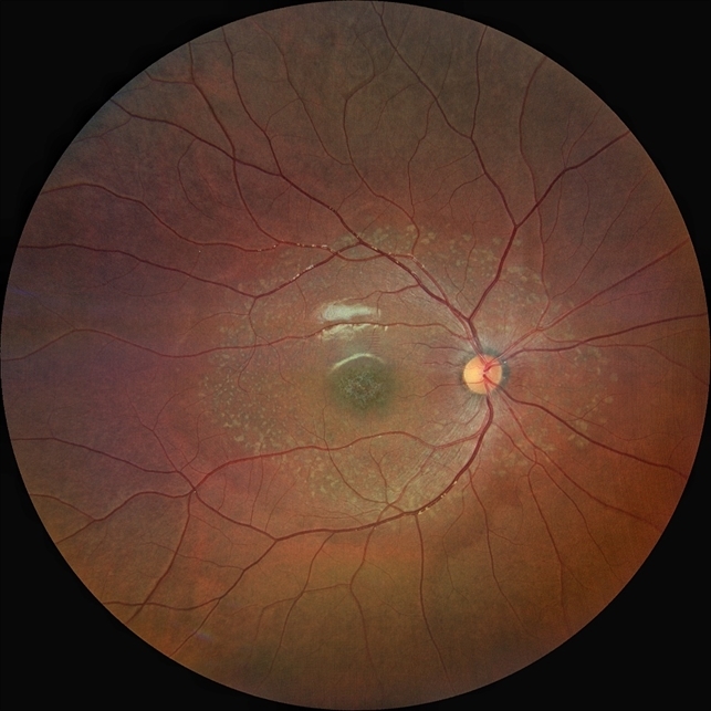 Болезнь Штаргардта, fundus flavimaculatus