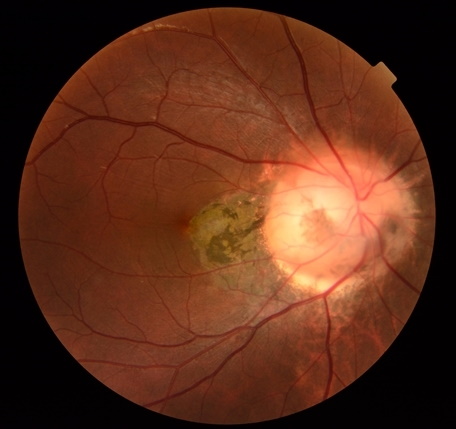 Колобома зрительного нерва