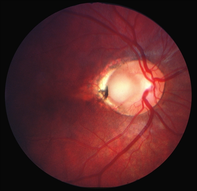 Колобома зрительного нерва