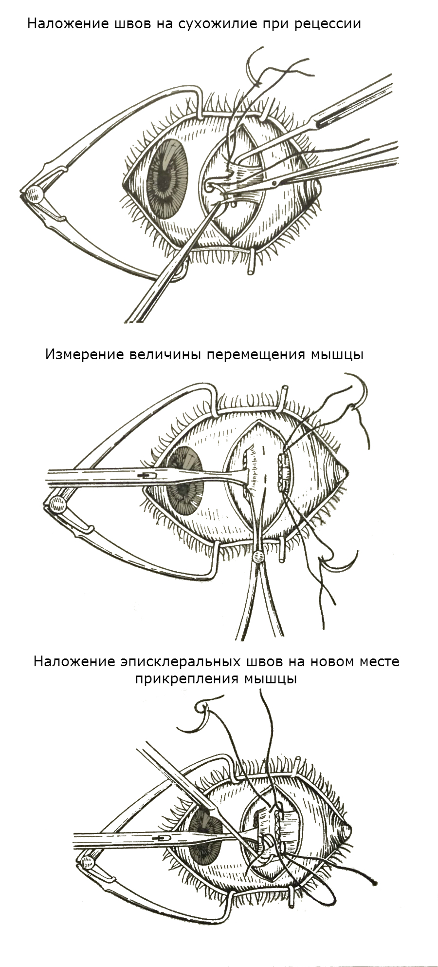 Этапы рецессии мышцы