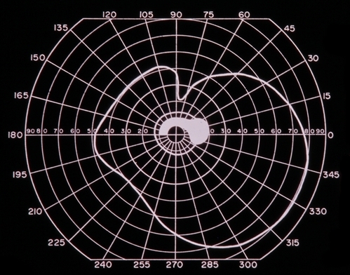Центральная скотома при ямке диска зрительного нерва