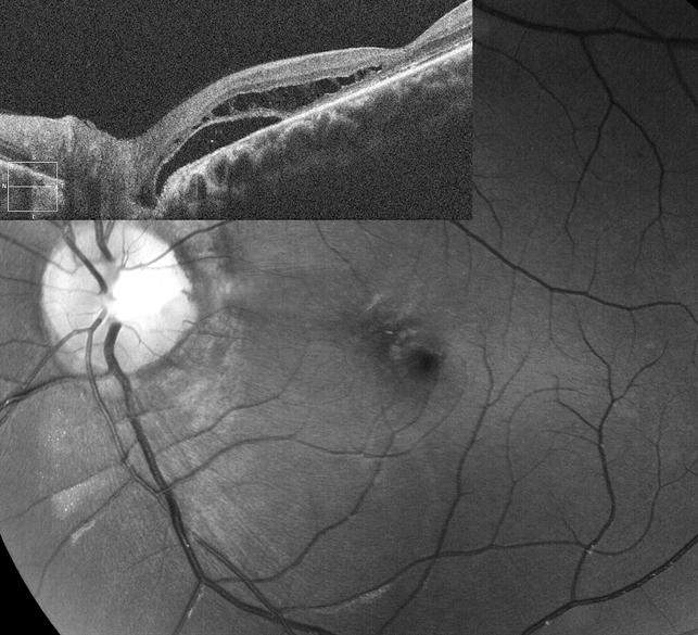 Ямка диска зрительного нерва с перипапиллярной макулярной отслойкой