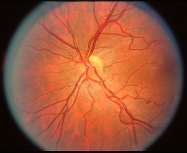 Косое вхождение диска зрительного нерва