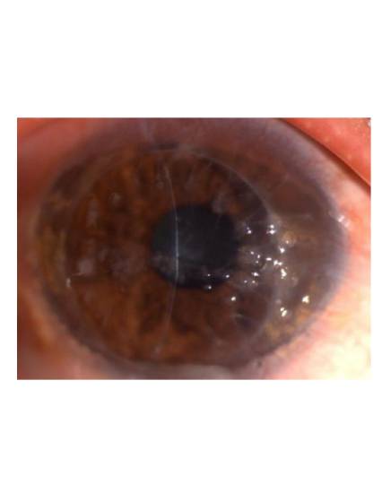 Каплевидная дистрофия