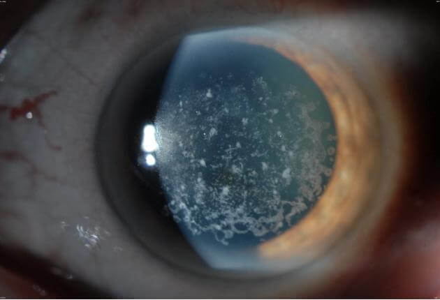 Дистрофия роговицы