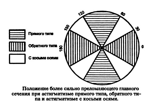Типы астигматизма