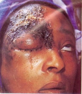 herpes zoster