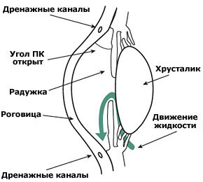 Угол передней камеры открыт, но дренажная  система не справляется с оттоком жидкости