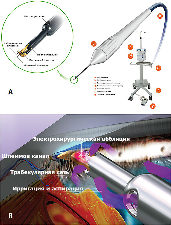 Трабекулотом 