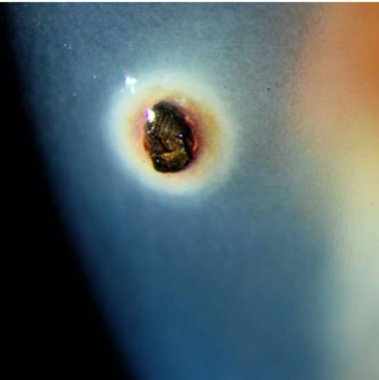 Инородное тело на роговице (окалина)