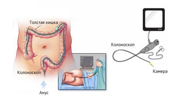 Колоноскопия Колоноскопия