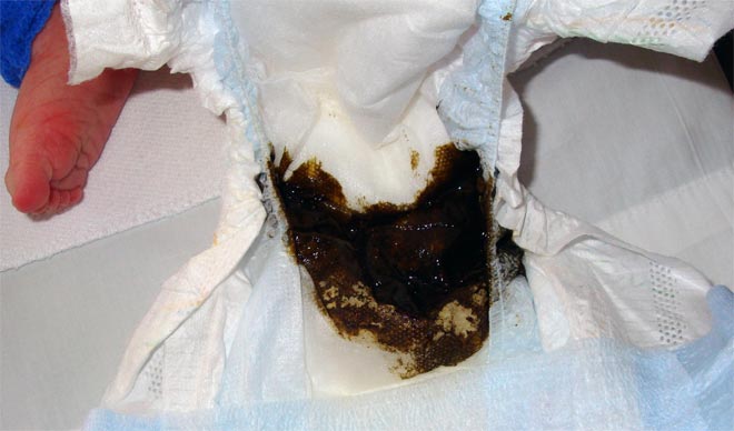 Черный понос черный понос у ребенка