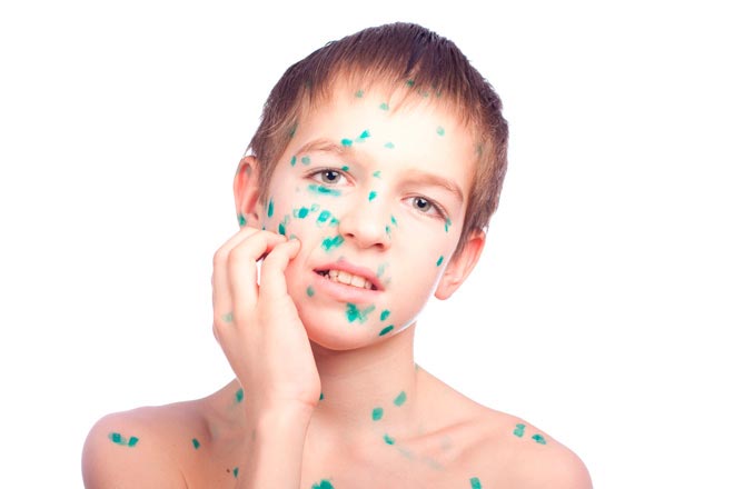 Ветряная оспа у ребенка Ветряная оспа у ребенка