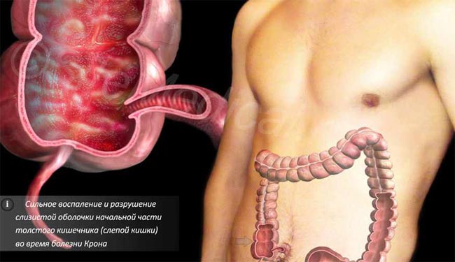 Воспалительная диарея воспаления в желудке