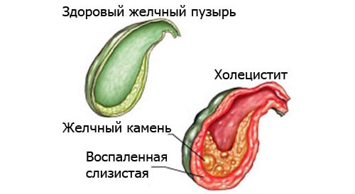 Заболевания жёлчного пузыря Заболевания жёлчного пузыря